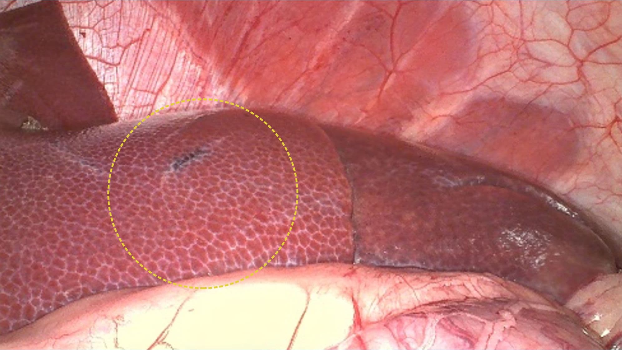 AI+ Microvascular Tissue Clarity Comparison - After